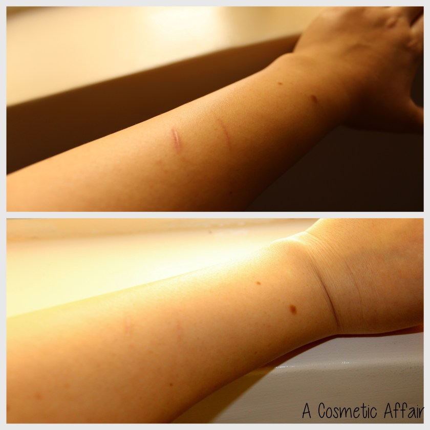 Bio Oil, acne, scars, blemishes